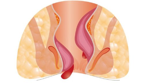 Az aranyér vizsgálata és kezelési lehetőségei