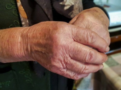 NEMCSAK AZ IDŐSEK KÖRÉBEN GYAKORI A REUMÁS MEGBETEGEDÉS