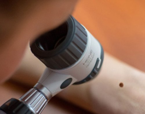 KEDVEZMÉNYES BŐRRÁKSZŰRÉS A KAPOS MEDICALNÁL!