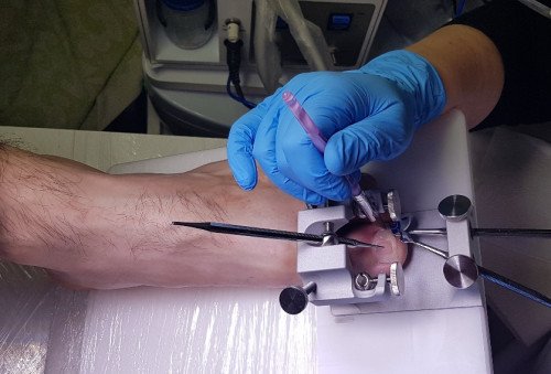 SPECIÁLIS KÖRÖMGYÓGYÁSZATI ELJÁRÁS A KAPOS MEDICALNÁL