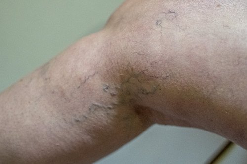 MINDEN, AMIT A MÉLYVÉNÁS TROMBÓZISRÓL TUDNI ÉRDEMES!